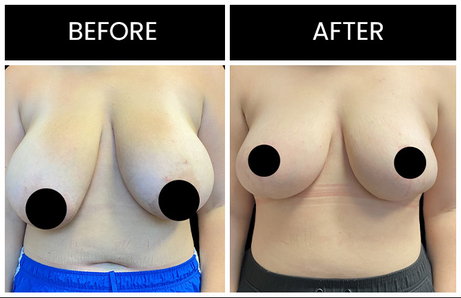 Breast Reduction Results Atlanta